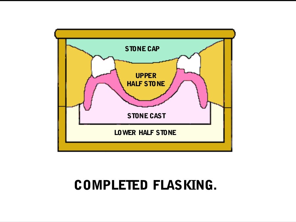 03 01 01_45(flasking and processing complete denture)