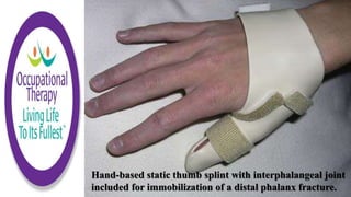 Hand-based static thumb splint with interphalangeal joint
included for immobilization of a distal phalanx fracture.
 