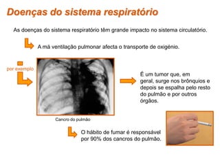 As doenças do sistema respiratório têm grande impacto no sistema circulatório.
A má ventilação pulmonar afecta o transporte de oxigénio.
por exemplo
É um tumor que, em
geral, surge nos brônquios e
depois se espalha pelo resto
do pulmão e por outros
órgãos.
O hábito de fumar é responsável
por 90% dos cancros do pulmão.
Doenças do sistema respiratório
Cancro do pulmão
 