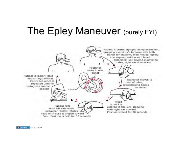 Epley maneuver pdf in spanish