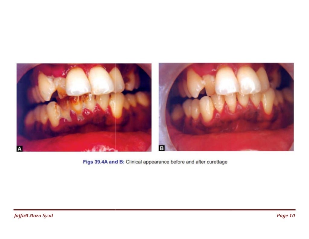 033.gingival curettage