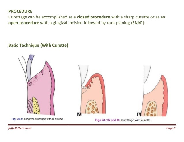 gingival curettage
