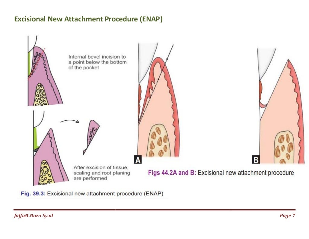033.gingival curettage