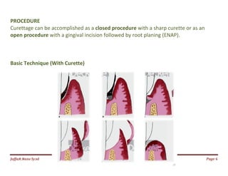 Jаffaя яaza Syзd Page 6
PROCEDURE
Curettage can be accomplished as a closed procedure with a sharp curette or as an
open procedure with a gingival incision followed by root planing (ENAP).
Basic Technique (With Curette)
 
