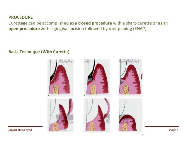 gingival curettage