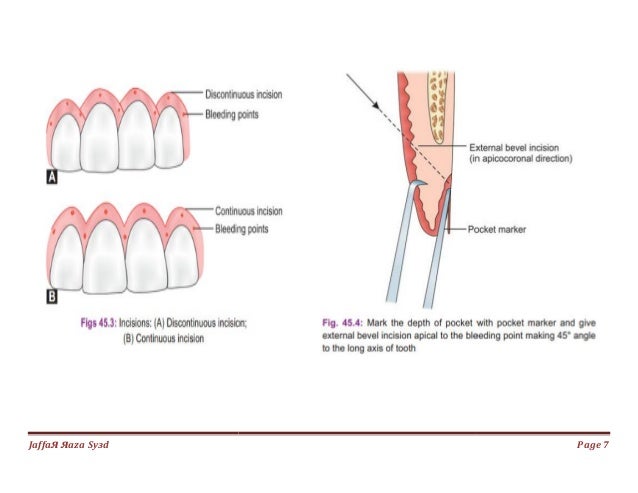 034.gingivectomy