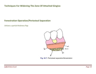 Jаffaя яaza Syзd
Techniques For Widening The Zone Of Attached Gingiva
Fenestration Operation/Periosteal Separation
Utilizes a partial thickness flap
Techniques For Widening The Zone Of Attached Gingiva
Fenestration Operation/Periosteal Separation
Page 18
 