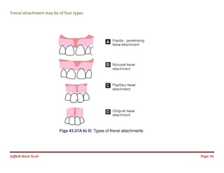 Jаffaя яaza Syзd
Frenal attachment may be of four types
Page 46
 