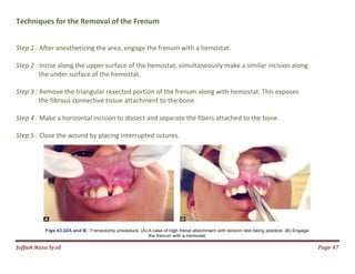 Jаffaя яaza Syзd
Techniques for the Removal of the
Step 1 : After anesthetizing the area, engage the frenum
Step 2 : Incise along the upper surface of the hemostat,
the under surface of the hemostat.
Step 3 : Remove the triangular resected portion of the
the fibrous connective tissue attachment to the bone.
Step 4 : Make a horizontal incision to dissect and separate
Step 5 : Close the wound by placing interrupted sutures.
Frenum
ing the area, engage the frenum with a hemostat.
Incise along the upper surface of the hemostat, simultaneously make a similar incision along
under surface of the hemostat.
angular resected portion of the frenum along with hemostat. This exposes
fibrous connective tissue attachment to the bone.
Make a horizontal incision to dissect and separate the fibers attached to the bone.
Close the wound by placing interrupted sutures.
Page 47
simultaneously make a similar incision along
frenum along with hemostat. This exposes
ached to the bone.
 
