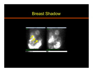 Breast Shadow
 