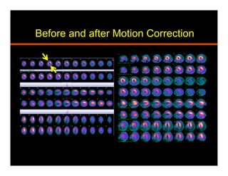 Before and after Motion Correction
 