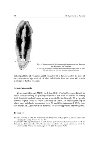 48 M. Vystrèilová, V. Novotný
not all problems of evaluation could be dealt with in full. Evidently, the issue of
the estimation of age at death of adult individual’s from the teeth will remain
a subject of further research.
Acknowledgements
We are grateful to prof. MUDr. Jan Kilian, DrSc. (Charles University, Pilsen) for
useful ideas and lending the grinding equipment as well as all the dentists for making
teeth from individuals of known age and sex available for this study. We are greatly
indebted to prof. David W. Frayer (University of Kansas) for checking the English
of this paper and also for commenting on it. We would like to thank prof. RNDr. Jaro-
slav Brùžek, Ph.D. (University of Bordeaux) for all his support and interesting ideas.
References
Brùžek J., Novotný V. 1999. Jak staøí umírali staøí Pøemyslovci aneb jak pøesná je pøesnost urèení vìku
jedince podle kostry. Vesmír, 78: 453–455.
Gustafson G. 1950. Age determination on teeth. Journal of the American Dental Association, 41: 45–54.
Komínek J., Rozkovcová E. 1984. Metoda urèování zubního vìku a její význam pro praxi. In:
Urban F. (ed.), Pokroky ve stomatologii 2: 175–208, Avicenum, Praha.
Fig. 4. Measurement of the thickness of cementum at the Kashyap
and Koteswara Rao’s method
ce1
, ce2
– the thickenings of cementum at the thickest point on either side of the tooth,
CE – the width of the tooth with cementum at the thickest point
ce1 ce2
CE
?
 