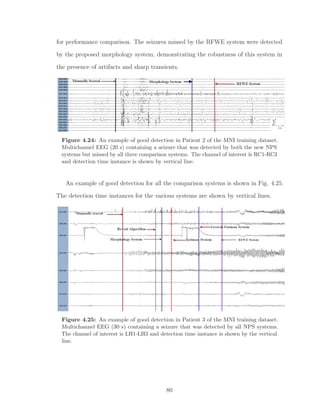 for performance comparison. The seizures missed by the RFWE system were detected
by the proposed morphology system, demonstrating the robustness of this system in
the presence of artifacts and sharp transients.
Figure 4.24: An example of good detection in Patient 2 of the MNI training dataset.
Multichannel EEG (20 s) containing a seizure that was detected by both the new NPS
systems but missed by all three comparison systems. The channel of interest is RC1-RC3
and detection time instance is shown by vertical line.
An example of good detection for all the comparison systems is shown in Fig. 4.25.
The detection time instances for the various systems are shown by vertical lines.
Figure 4.25: An example of good detection in Patient 3 of the MNI training dataset.
Multichannel EEG (30 s) containing a seizure that was detected by all NPS systems.
The channel of interest is LH1-LH3 and detection time instance is shown by the vertical
line.
80
 