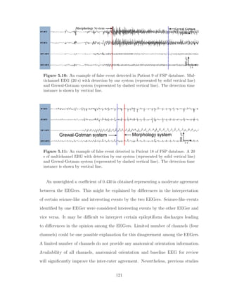 Figure 5.10: An example of false event detected in Patient 9 of FSP database. Mul-
tichannel EEG (20 s) with detection by our system (represented by solid vertical line)
and Grewal-Gotman system (represented by dashed vertical line). The detection time
instance is shown by vertical line.
Figure 5.11: An example of false event detected in Patient 18 of FSP database. A 20
s of multichannel EEG with detection by our system (represented by solid vertical line)
and Grewal-Gotman system (represented by dashed vertical line). The detection time
instance is shown by vertical line.
An unweighted κ coeﬃcient of 0.430 is obtained representing a moderate agreement
between the EEGers. This might be explained by diﬀerences in the interpretation
of certain seizure-like and interesting events by the two EEGers. Seizure-like events
identiﬁed by one EEGer were considered interesting events by the other EEGer and
vice versa. It may be diﬃcult to interpret certain epileptiform discharges leading
to diﬀerences in the opinion among the EEGers. Limited number of channels (four
channels) could be one possible explanation for this disagreement among the EEGers.
A limited number of channels do not provide any anatomical orientation information.
Availability of all channels, anatomical orientation and baseline EEG for review
will signiﬁcantly improve the inter-rater agreement. Nevertheless, previous studies
121
 