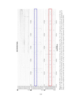 13:15:1413:15:1913:15:2413:15:2913:15:3413:15:39
LFC3-LFC5
LFC1-LFC3
LH7-LH8
LH5-LH7
LH3-LH5
LH1-LH3
LA7-LA8
LA5-LA7
LA3-LA5
LA1-LA3
11:33:4411:33:4911:33:5411:33:5911:34:0411:34:09
LFC3-LFC5
LFC1-LFC3
LH7-LH8
LH5-LH7
LH3-LH5
LH1-LH3
LA7-LA8
LA5-LA7
LA3-LA5
LA1-LA3
14:31:5414:31:5914:32:0414:32:0914:32:1414:32:19
LFC3-LFC5
LFC1-LFC3
LH7-LH8
LH5-LH7
LH3-LH5
LH1-LH3
LA7-LA8
LA5-LA7
LA3-LA5
LA1-LA3
A
TIME[HH:MM:SS]
C
B
EEGREVIEWPANEL
Figure5.15:EEGcorrespondingtotheeventsselectedfromtheRSIdisplayinFig.5.14.(A)representsaseizurearoundthetime
point’1’,(B)representsthepre-ictalrhythmicdischargeofsharpwavesaroundthetimepoint’2’,and(C)representsdischargesof
sharpwavecomplexesaroundthetimepoint’3’inFig.5.13,respectively.Eachsegmentrepresents30sof10channelEEG.
130
 