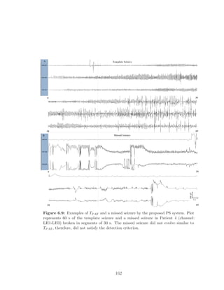 Figure 6.9: Examples of TPAT and a missed seizure by the proposed PS system. Plot
represents 60 s of the template seizure and a missed seizure in Patient 4 (channel:
LH1-LH3) broken in segments of 30 s. The missed seizure did not evolve similar to
TPAT , therefore, did not satisfy the detection criterion.
162
 