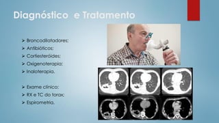Diagnóstico e Tratamento
⮚ Broncodilatadores;
⮚ Antibióticos;
⮚ Cortiesteróides;
⮚ Oxigenoterapia;
⮚ Inaloterapia.
⮚ Exame clínico;
⮚ RX e TC do torax;
⮚ Espirometria.
 