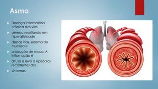 Asma
 Doença inflamatória
crônica das vias
 aéreas, resultando em
hiperatividade
 dessas vias, edema de
mucosa e
 produção de muco. A
inflamação é
 difusa e leva a episódios
recorrentes dos
 sintomas.
 