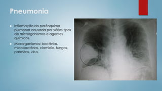 Pneumonia
 Inflamação do parênquima
pulmonar causada por vários tipos
de microrganismos e agentes
químicos.
 Microrganismos: bactérias,
micobactérias, clamídia, fungos,
parasitas, vírus.
 
