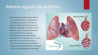 Edema agudo de pulmão
O Edema Agudo de Pulmão (EAP) é
um aumento súbito na pressão dos
capilares pulmonares, levando ao
extravasamento de líquido para os
alvéolos, deixando o pulmão menos
elástico e com menos superfície de
contato para troca de gases,
manifestando-se por dificuldade
respiratória. É um quadro clínico crítico,
decorrente da incapacidade do
ventrículo esquerdo em bombear o
sangue para válvula aórtica, causando
um acúmulo de líquido nos pulmões.
 