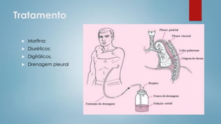 Tratamento
 Morfina;
 Diuréticos;
 Digitálicos.
 Drenagem pleural
 