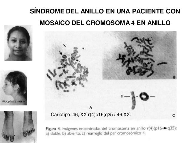 03 alteraciones cromosómicas estructurales