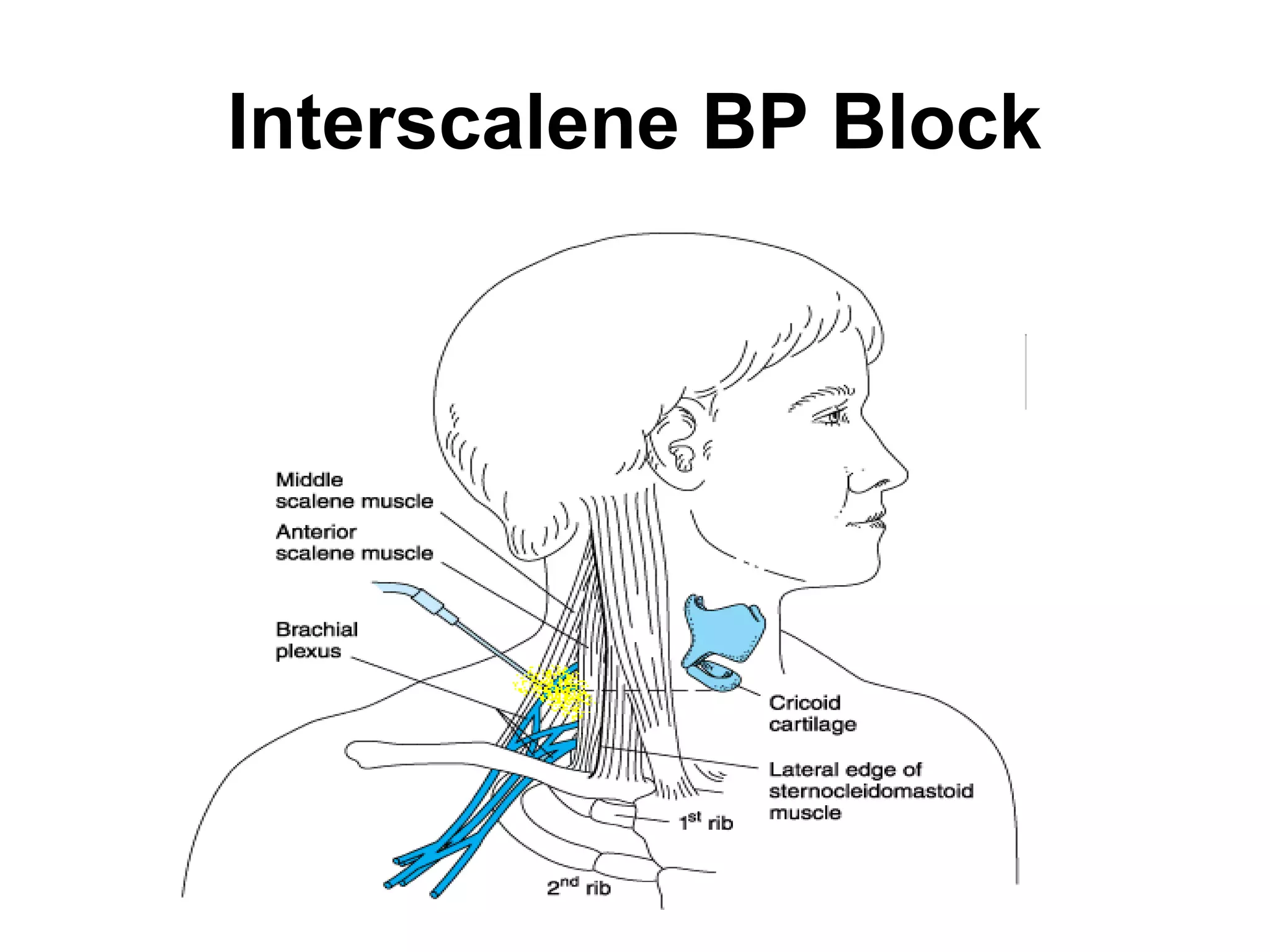 Interscalene BP Block
 