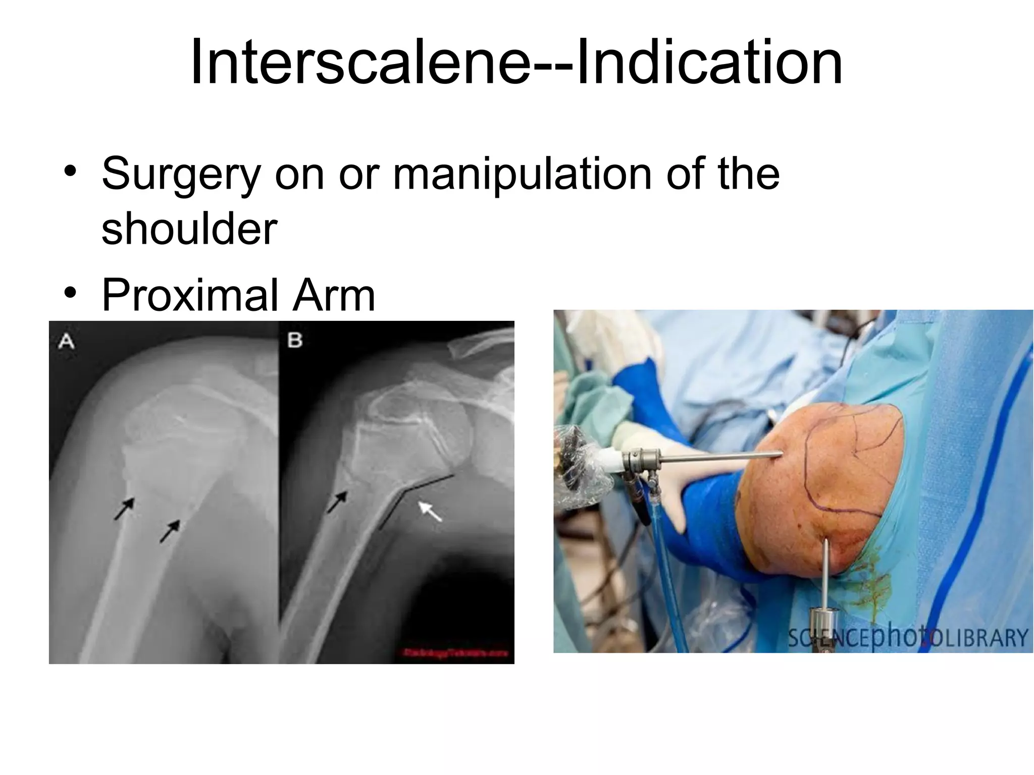 Interscalene--Indication
• Surgery on or manipulation of the
shoulder
• Proximal Arm
 