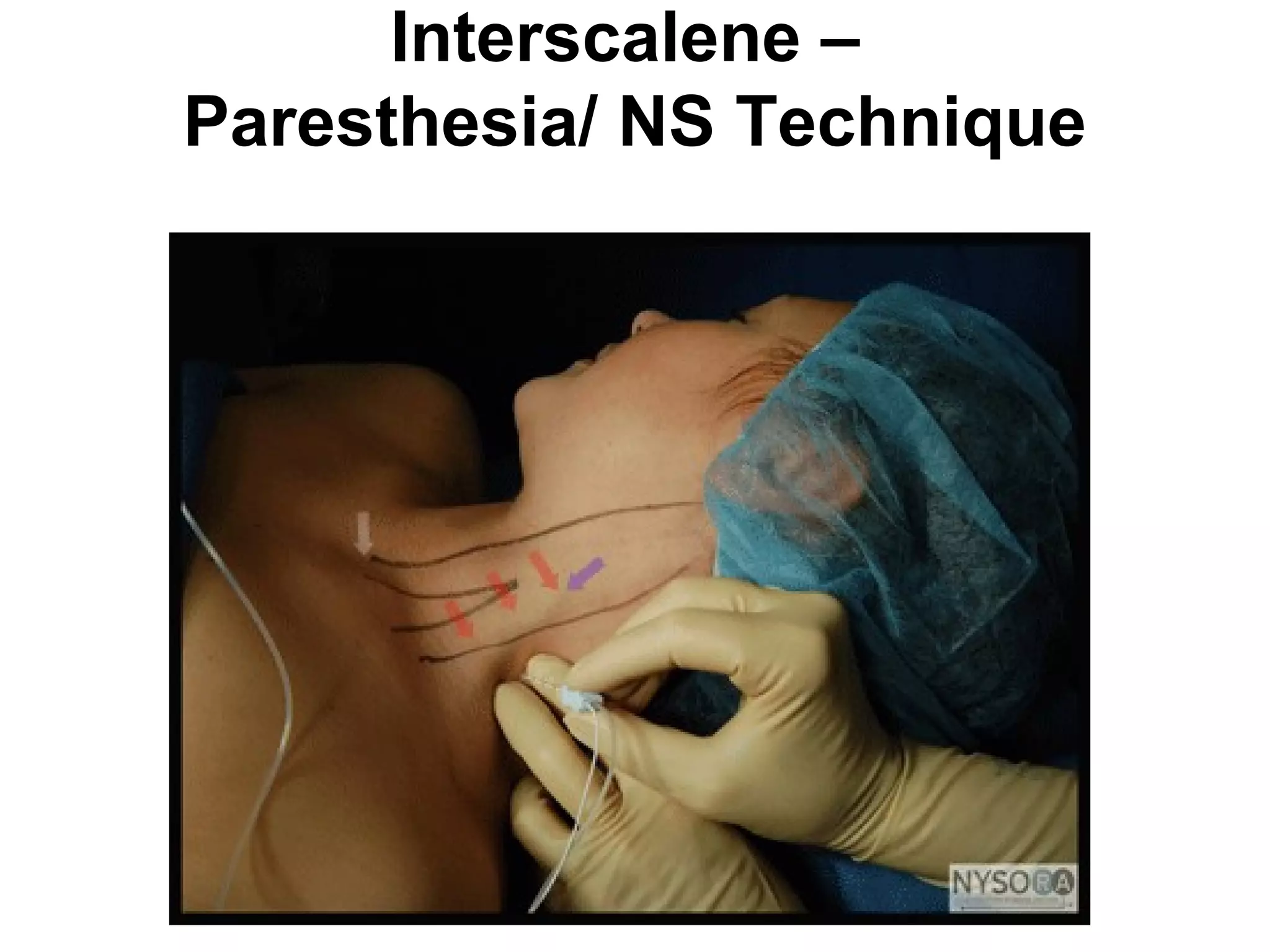 Interscalene –
Paresthesia/ NS Technique
 