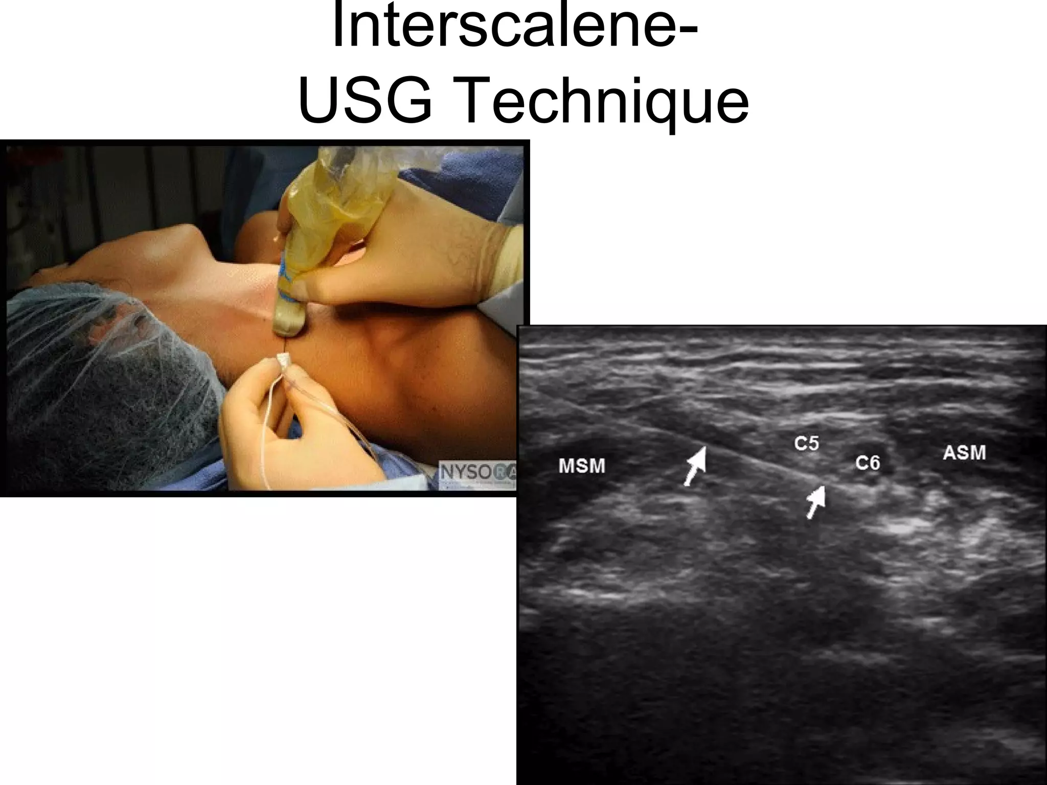 Interscalene-
USG Technique
 
