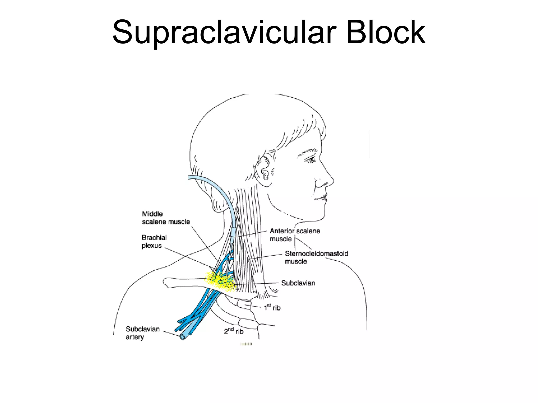 Supraclavicular Block
 