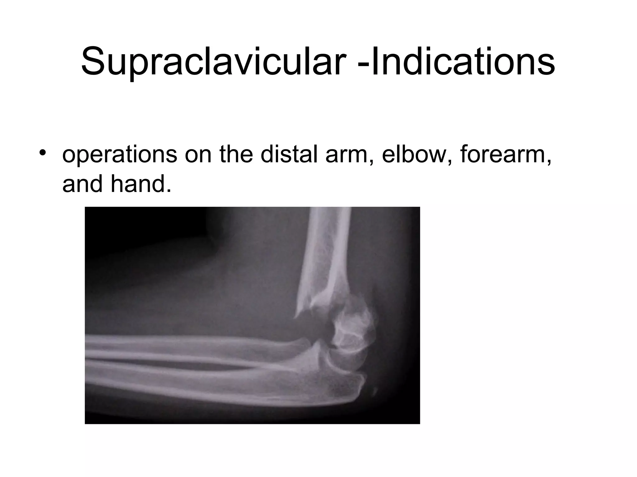 Supraclavicular -Indications
• operations on the distal arm, elbow, forearm,
and hand.
 