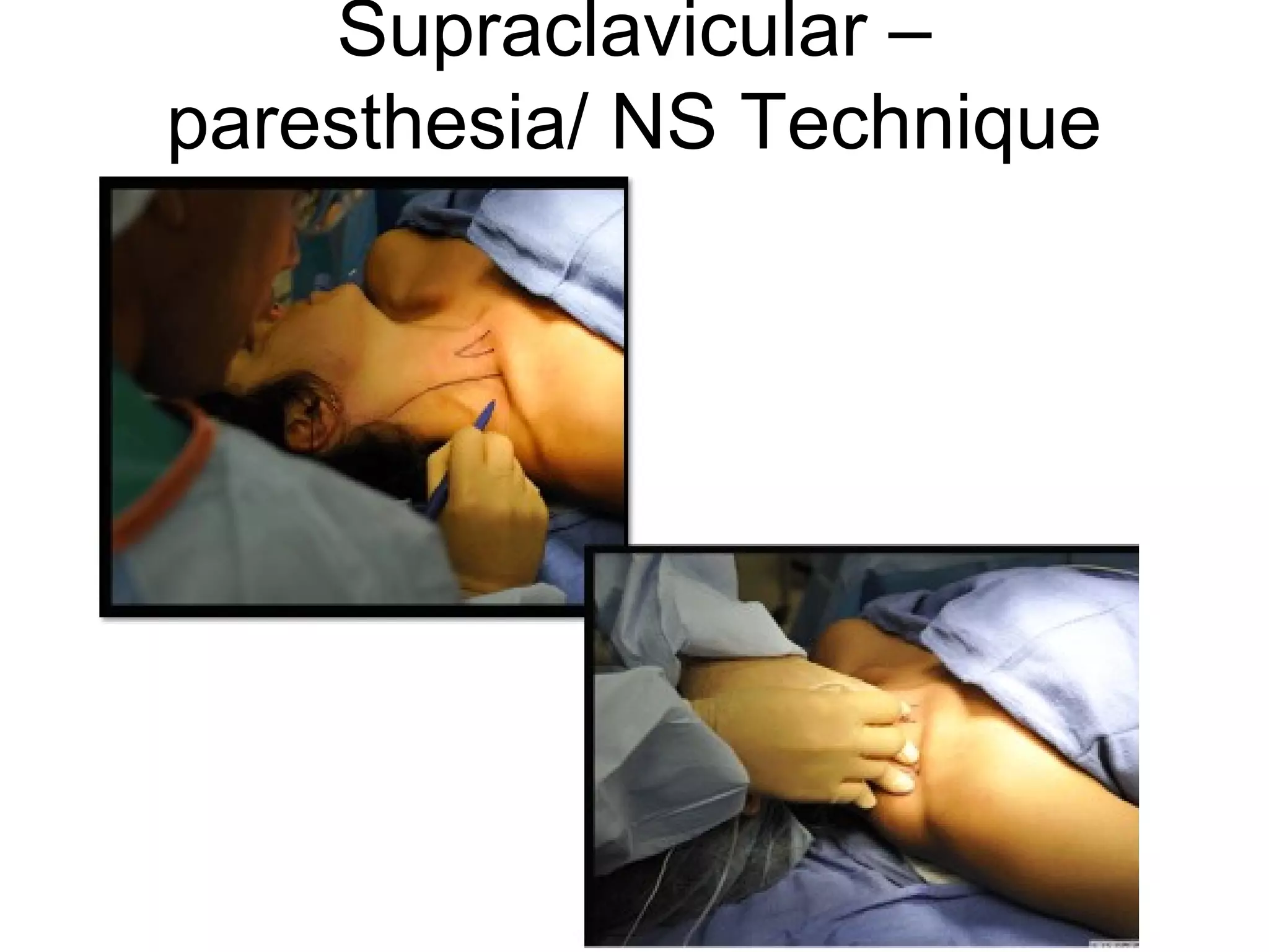 Supraclavicular –
paresthesia/ NS Technique
 