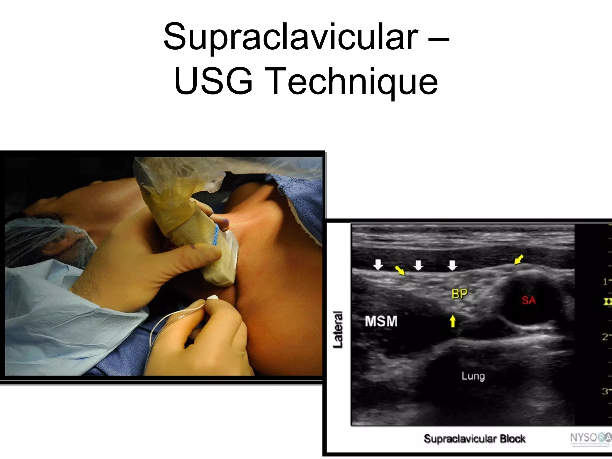Supraclavicular –
USG Technique
 