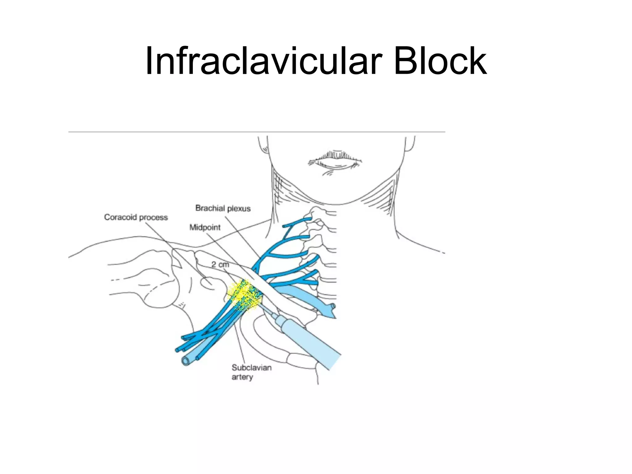 Infraclavicular Block
 