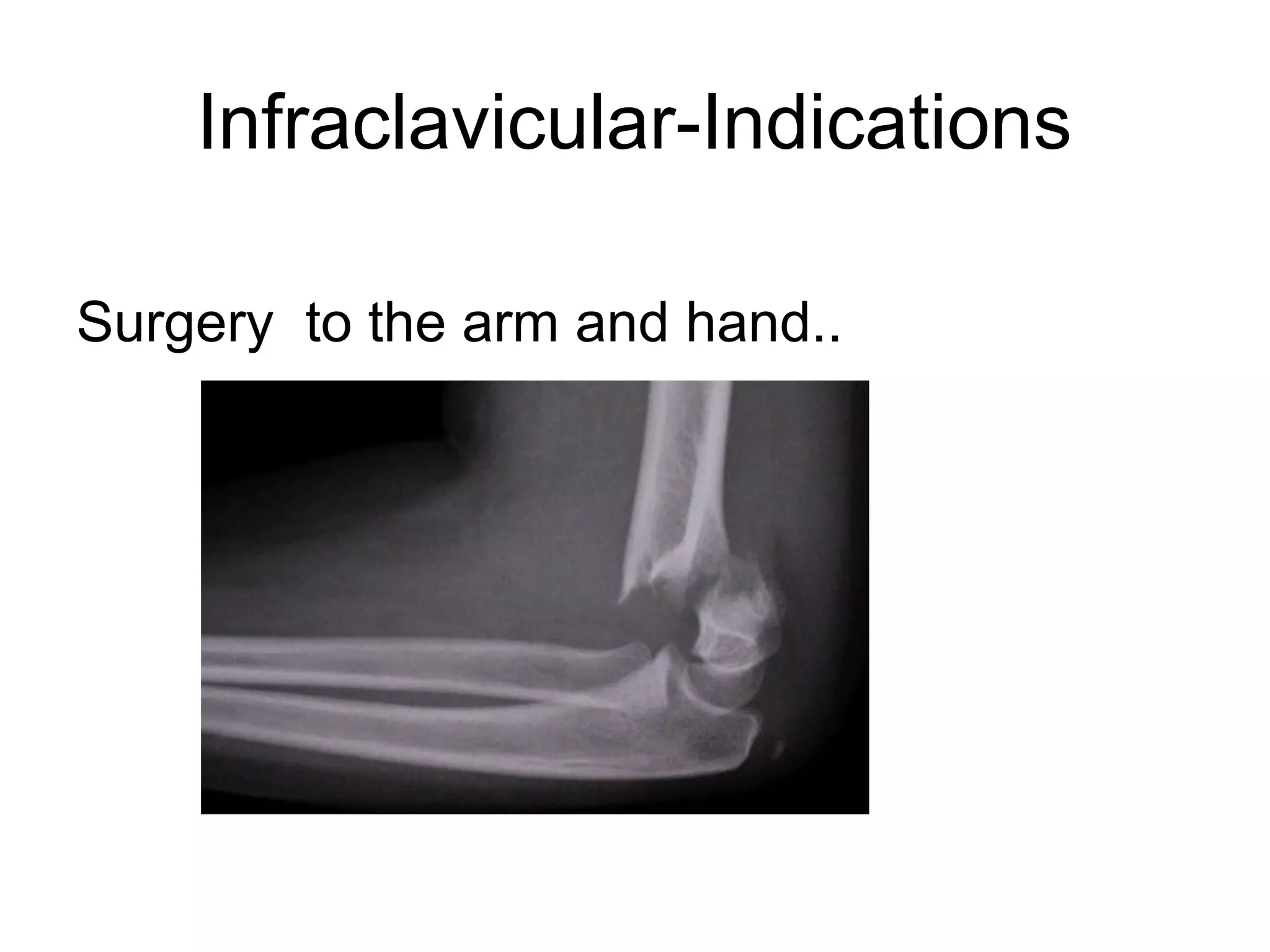 Infraclavicular-Indications
Surgery to the arm and hand..
 