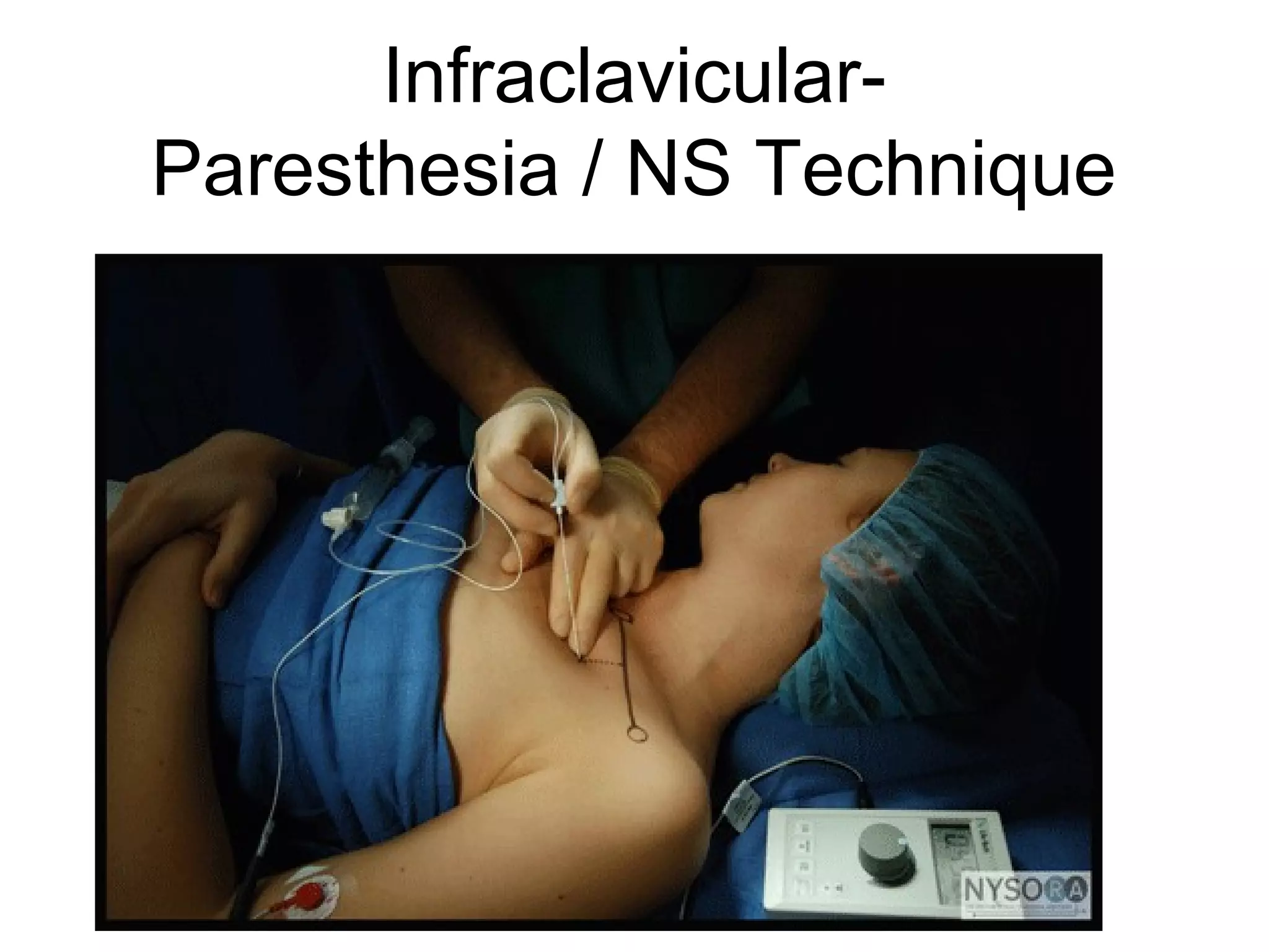 Infraclavicular-
Paresthesia / NS Technique
 