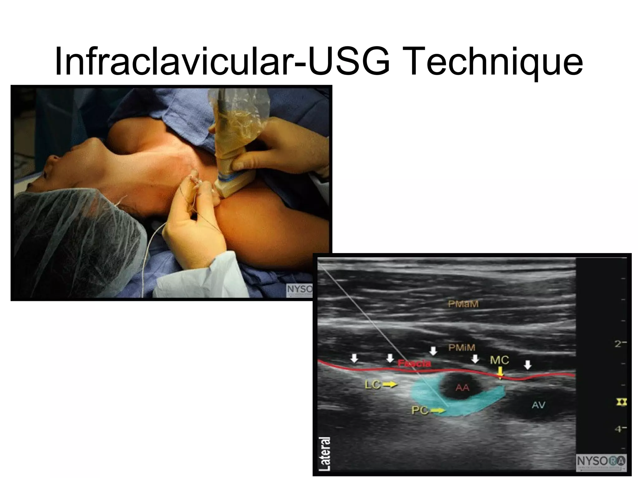 Infraclavicular-USG Technique
 