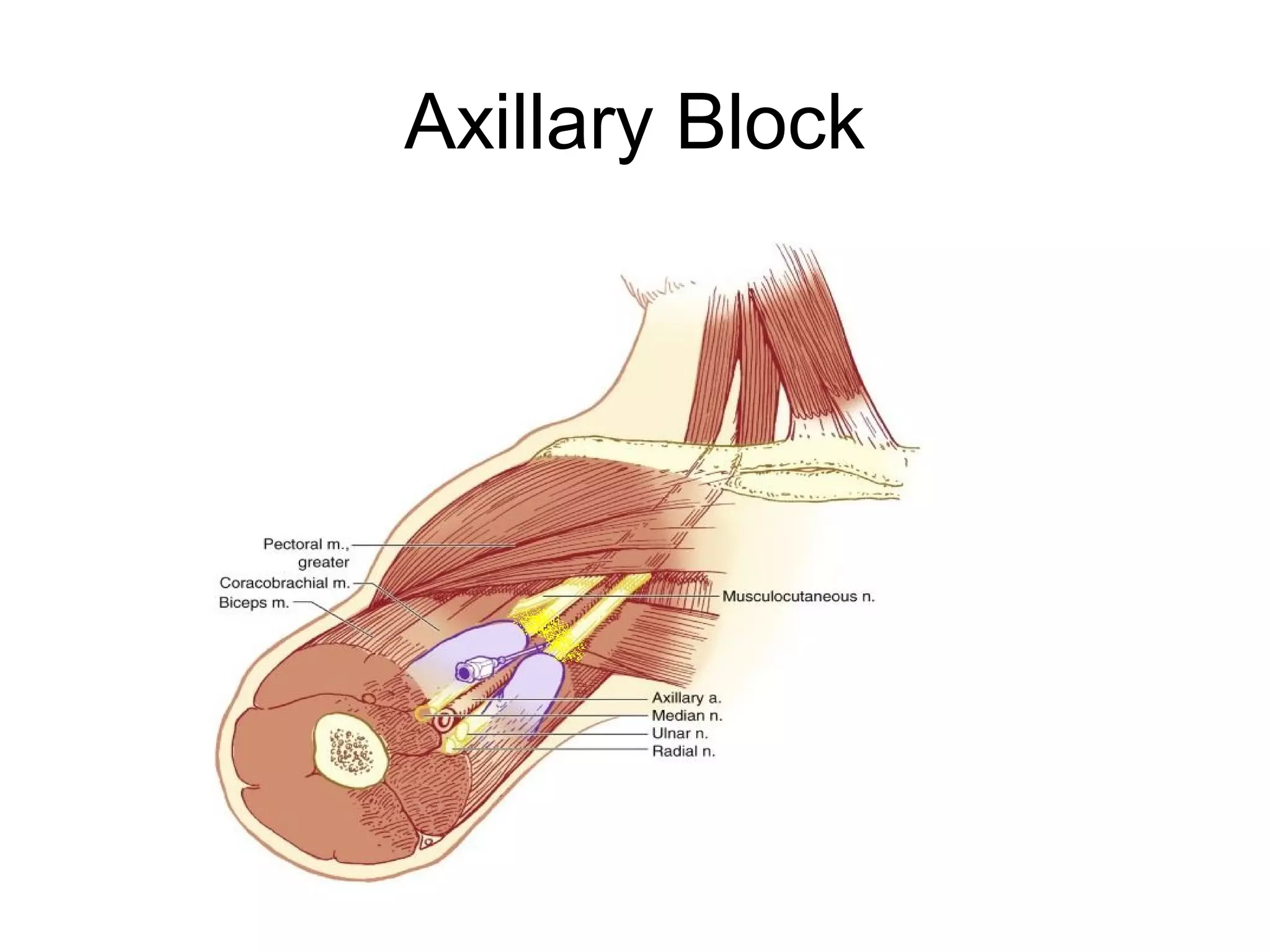 Axillary Block
 