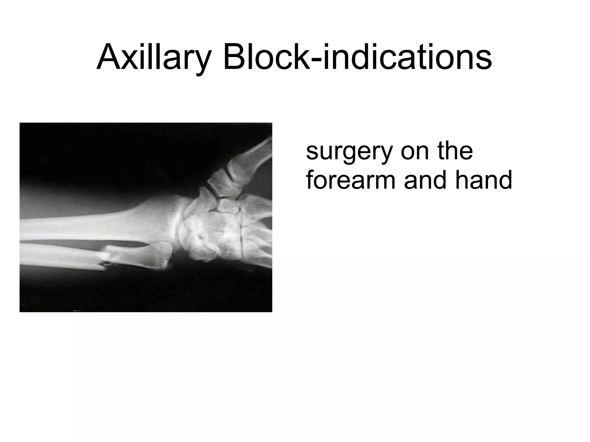 Axillary Block-indications
surgery on the
forearm and hand
 