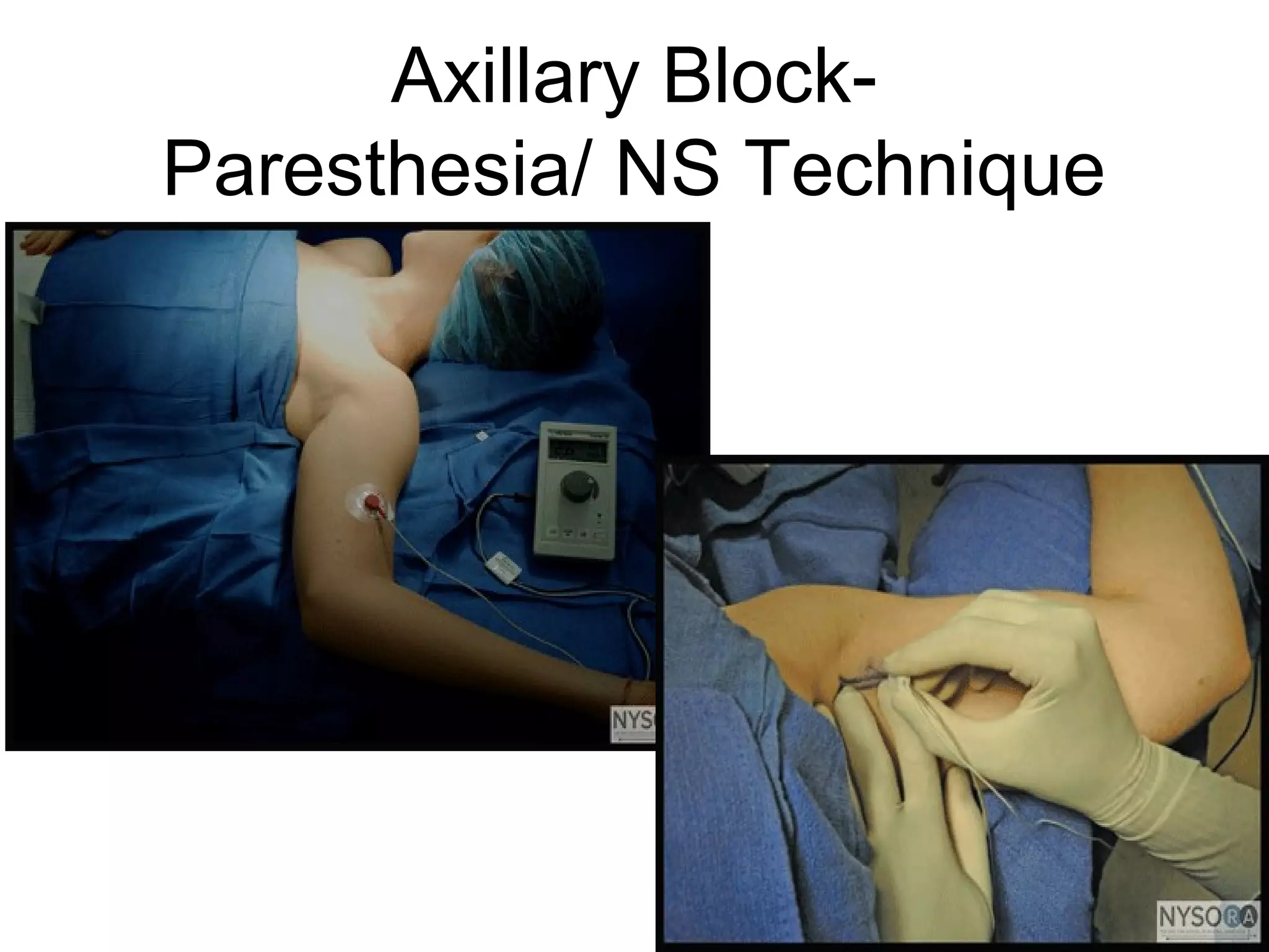 Axillary Block-
Paresthesia/ NS Technique
 