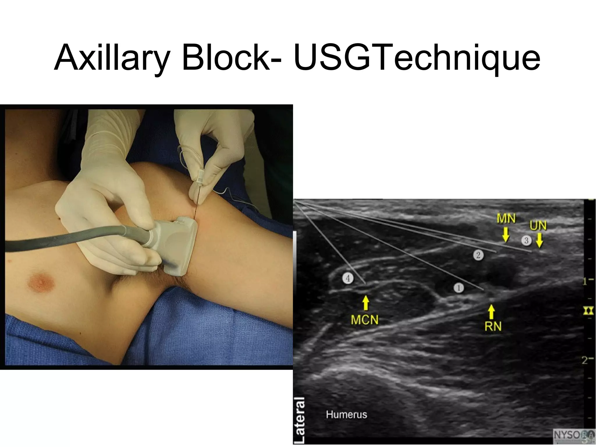 Axillary Block- USGTechnique
 