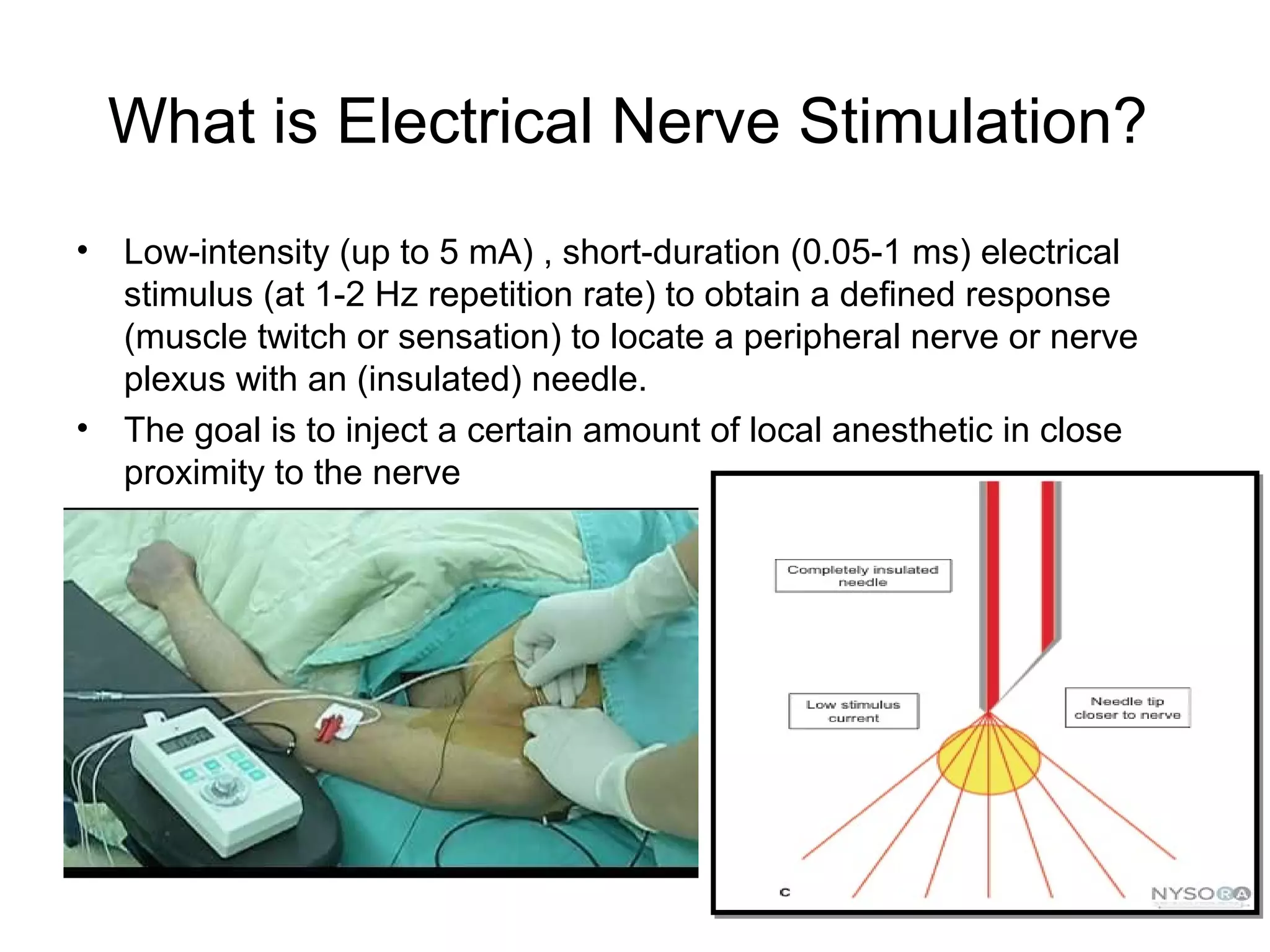 What is Electrical Nerve Stimulation?
• Low-intensity (up to 5 mA) , short-duration (0.05-1 ms) electrical
stimulus (at 1-2 Hz repetition rate) to obtain a defined response
(muscle twitch or sensation) to locate a peripheral nerve or nerve
plexus with an (insulated) needle.
• The goal is to inject a certain amount of local anesthetic in close
proximity to the nerve
 