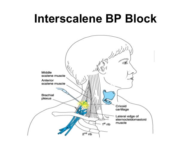 supraclavicular block thesis supraclavicular block thesis