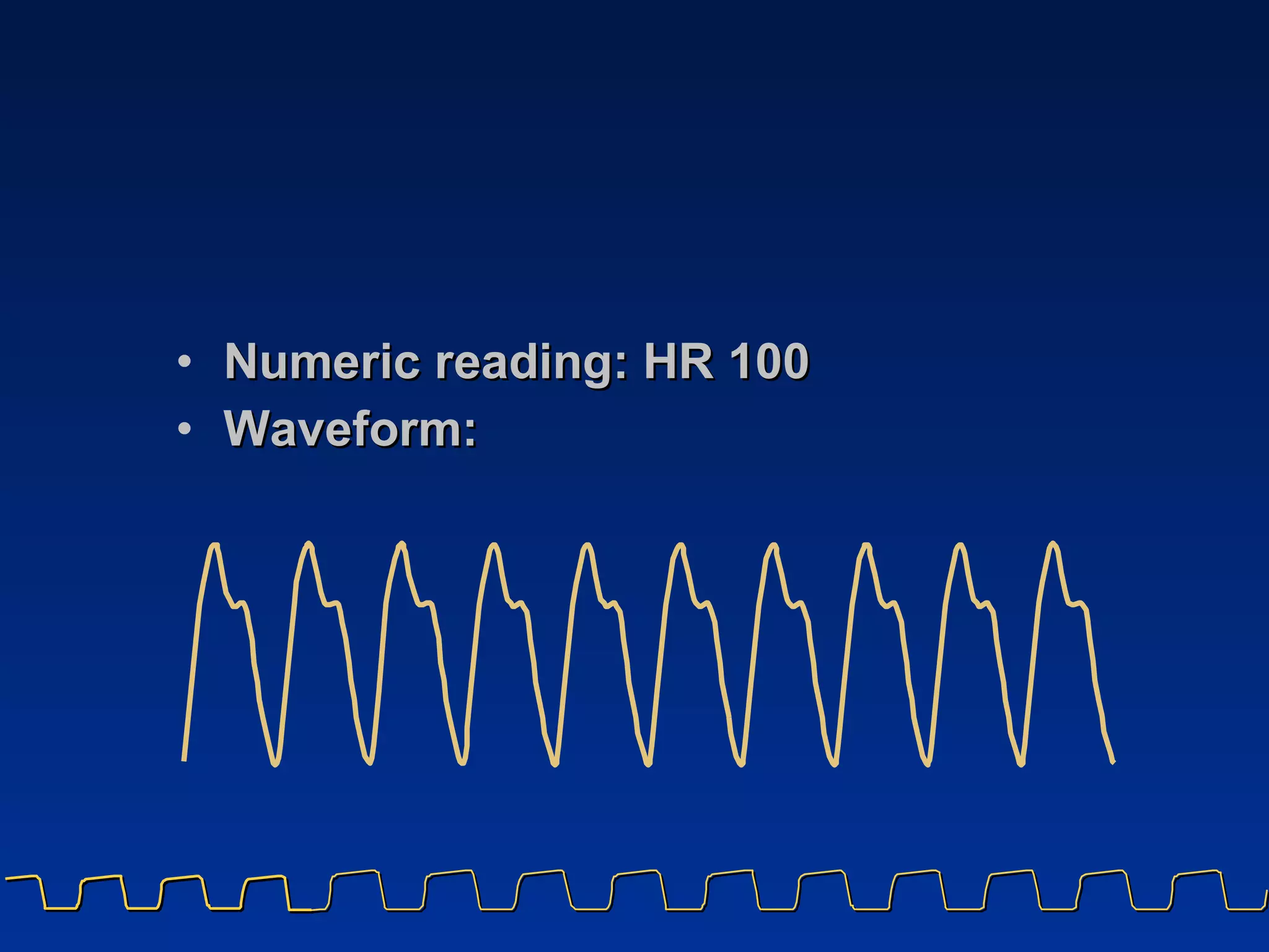Numeric reading: HR 100 Waveform: 