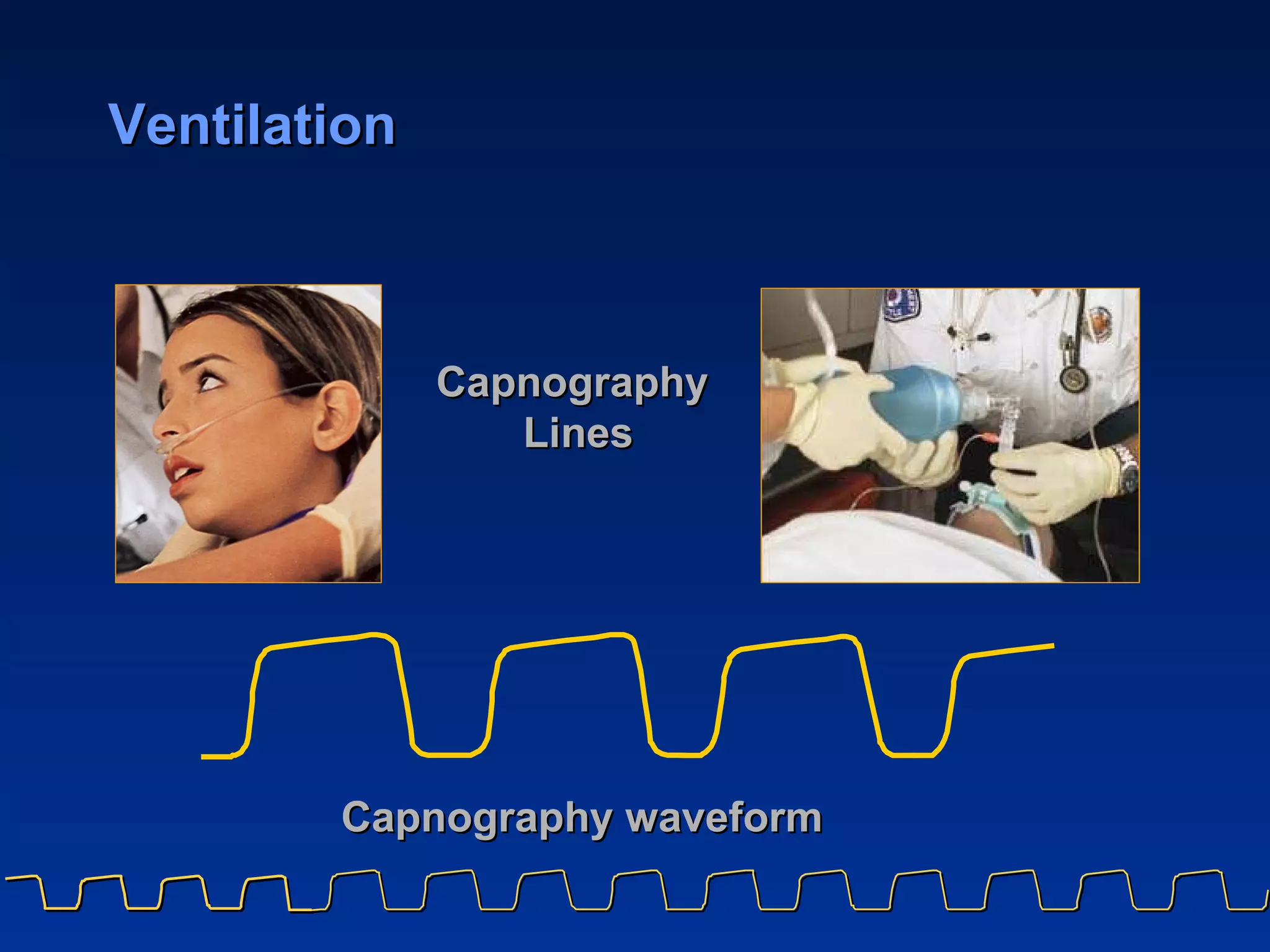 Ventilation Capnography waveform Capnography  Lines 