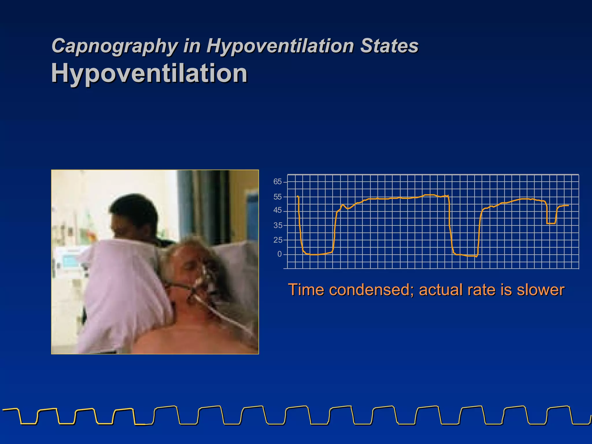 Capnography in Hypoventilation States  Hypoventilation Time condensed; actual rate is slower 