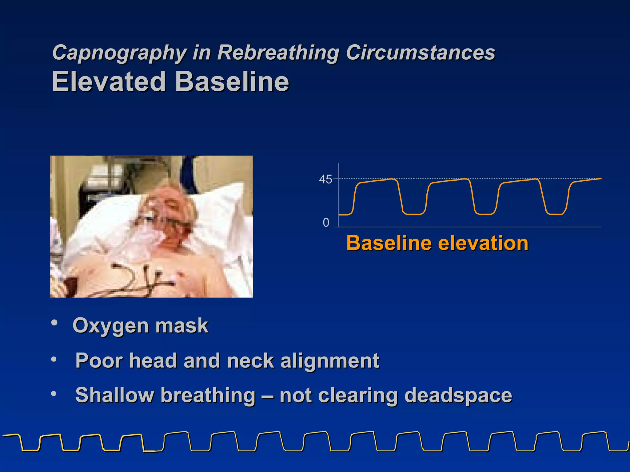 Capnography in Rebreathing Circumstances   Elevated Baseline  Baseline elevation Oxygen mask Poor head and neck alignment Shallow breathing – not clearing deadspace 4 5 0 