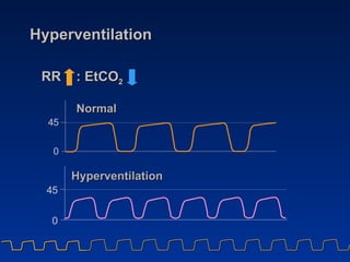 Hyperventilation <ul><li>RR  : EtCO 2 </li></ul>4 5 0 Normal Hyperventilation 