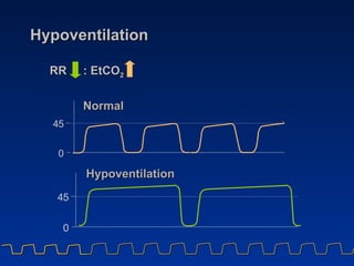 Hypoventilation RR  : EtCO 2 Normal Hypoventilation 4 5 0 4 5 0 